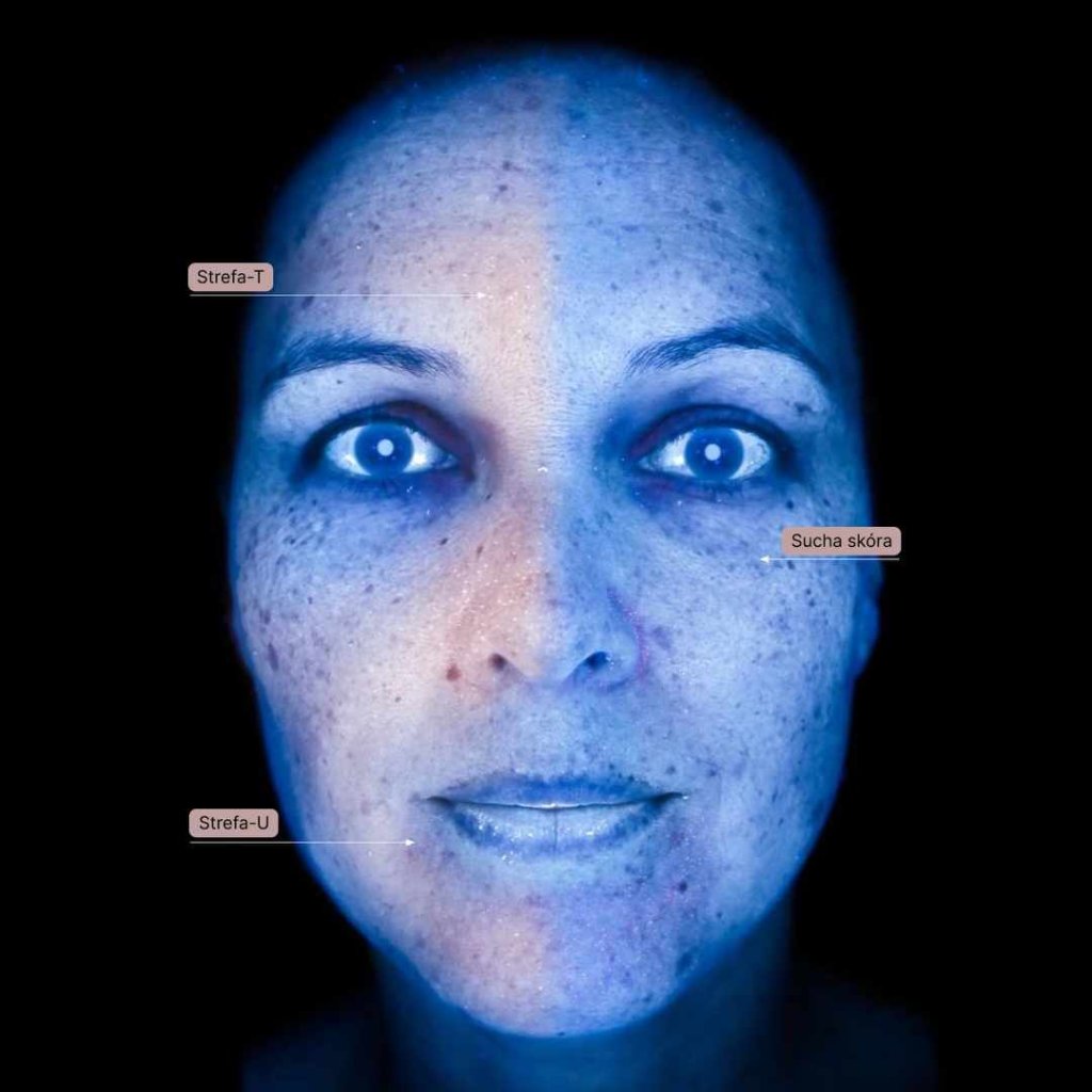 analiza skóry Zakopane - skóra w świetle ultrafioletowym z widocznymi problemami dermatologicznymi - diagnostyka dostępna w Paro Clinic