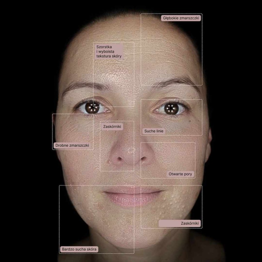 analiza skóry - Observ 520x - problemy skórne zdiagnozowane z wykorzystaniem najnowszej technologii w Paro Clinic - Zakopane